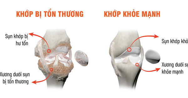 Sống tự chủ hơn nhờ chăm sóc xương khớp đúng cách